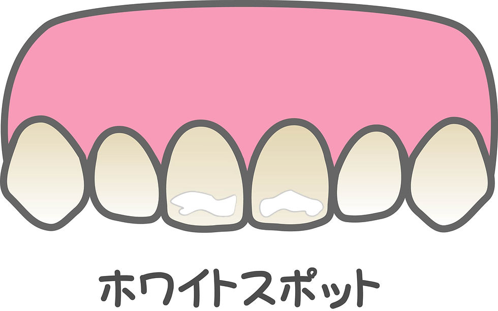ピンクの歯ぐきと白い歯のイラスト。前歯に白い斑点があり、下にホワイトスポットと書かれている。