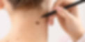 mole removal Cozumel rejuvenation clinic