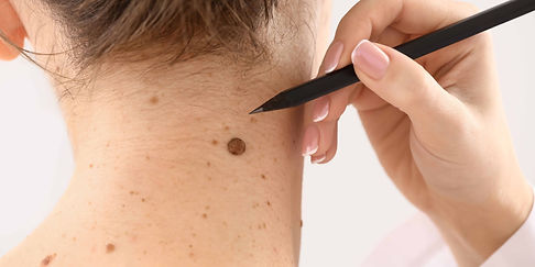 mole removal Cozumel rejuvenation clinic