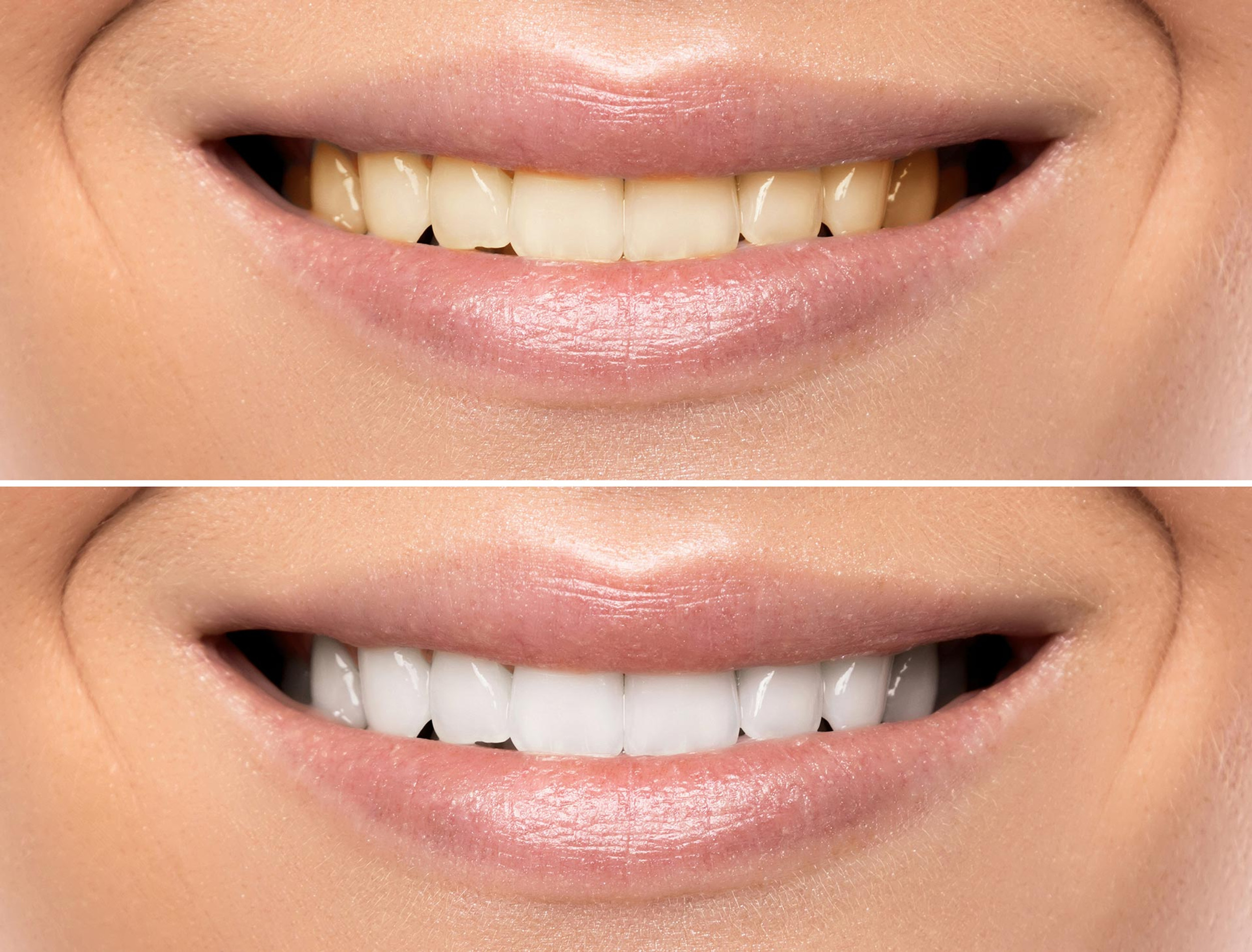 Organic Teeth Whitening Modern Teeth Whitening Studio Eagle Mountain