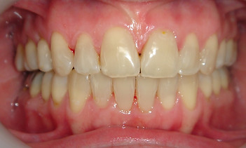 invisalign Guérande