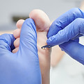 Callus shaving with a nurse wearing gloves