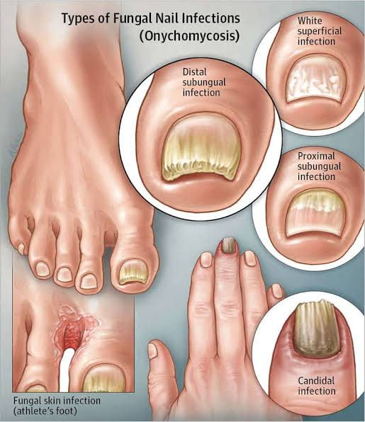 Infographic of fungal nail infections and athlete’s foot, showing feet and hands with discolored nails and labeled infection types.