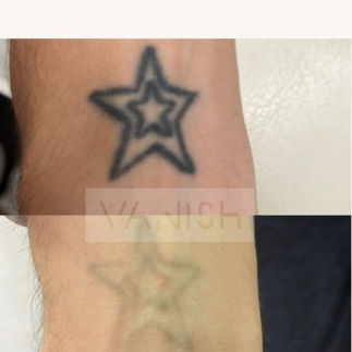 laser tattoo removal