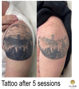 vanish tattoo removal