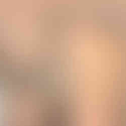 laser tattoo removal