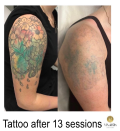 vanish tattoo removal