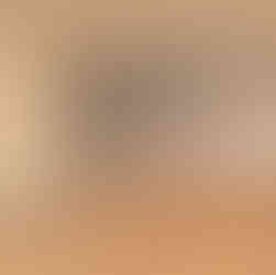 laser tattoo removal