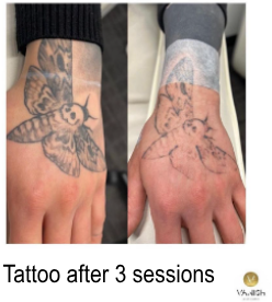 vanish tattoo removal