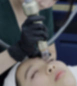 Sylfirm X RF microneedling treatment for skin rejuvenation, improving texture, firmness, and reducing pigmentation.