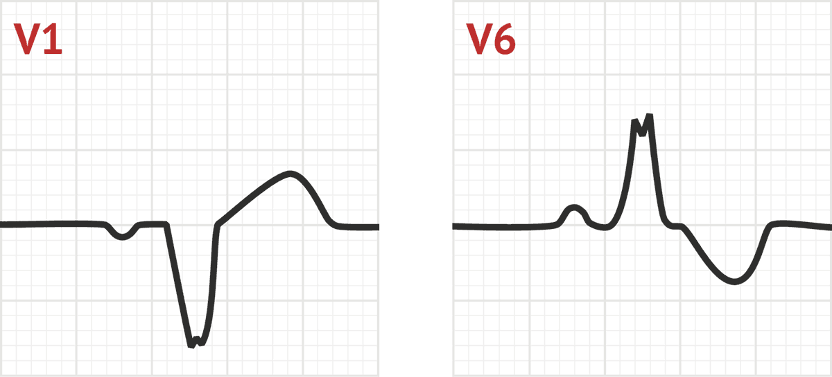 lbbb.gif