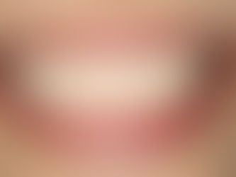 部分矯正(MTM)について