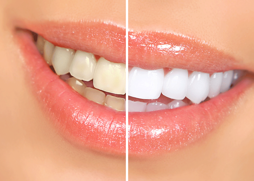 how-does-professional-teeth-whitening-work.gif