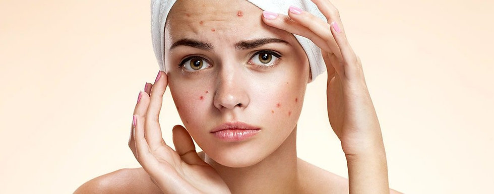 Acne005.jpeg