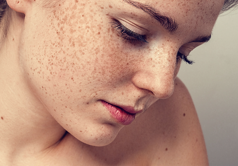 melasma07.png