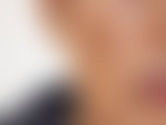 Melasma Treatment in Dubai