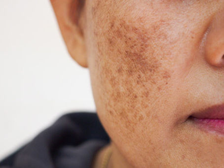 Melasma Treatment in Dubai