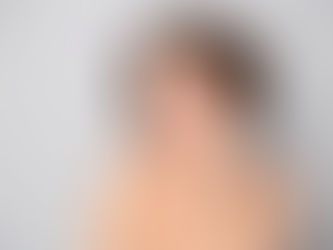 Skin Resurfacing in Dubai