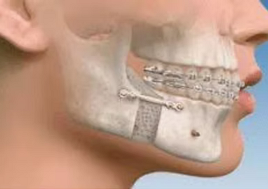 Orthognathic surgery.png