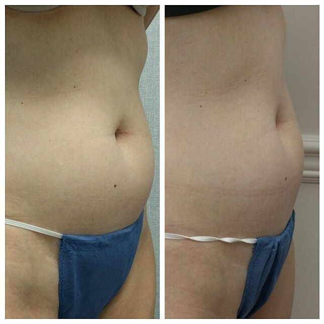 Ultrashape body contouring
