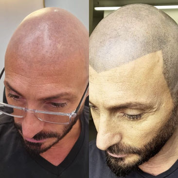 הסרת קעקועים הסרת איפור קבוע לייזר להסרת קעקועים הסרת קעקועים ללא צלקות הסרת קעקועים בטכנולוגיה מתקדמת הסרנו Hesarnu Tattoo removal Permanent makeup removal Laser tattoo removal Tattoo removal without scarring Advanced tattoo removal technology Hesarnu