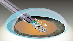 前嚢切開のイメージ