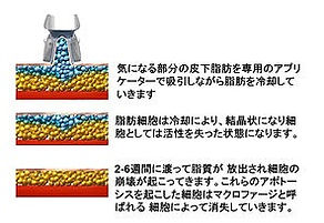痩身 脂肪冷却のよる皮下脂肪除去