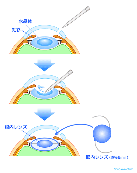 白内障手術の流れ