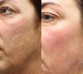 Improved skin after microneedling and infrared light therapy.png