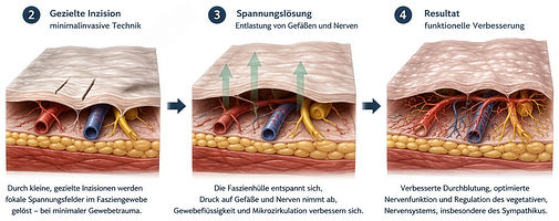 Minimal-invasive Faszieninzision zur Regulation des Nervensystems und Verbesserung der Mikrozirkulation
