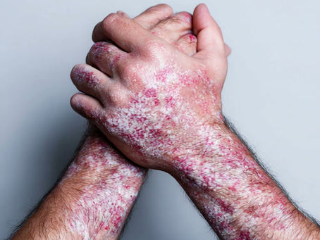 Hände mit Psoriasis und schuppiger Haut bei chronischer Schuppenflechte