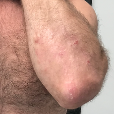 Psoriasis-Therapieverlauf nach 7 Monaten ganzheitlicher Behandlung