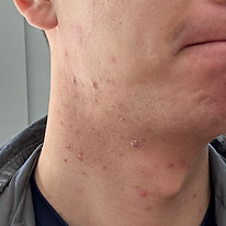 Sichtbare Verbesserung chronischer Akne nach ganzheitlicher Therapie