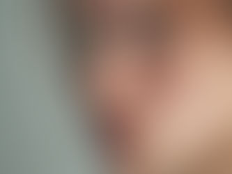 Junge Frau mit Akne und entzündlichen Hautunreinheiten im Gesicht