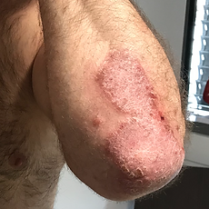 Psoriasis am Ellenbogen vor ganzheitlicher Behandlung