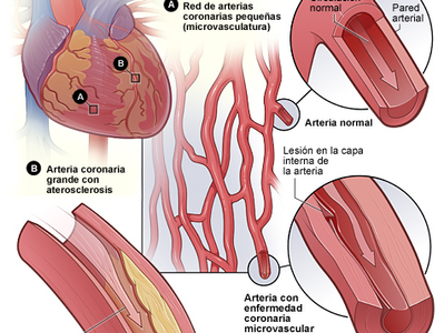 Angina de pecho: cuidando tu corazón