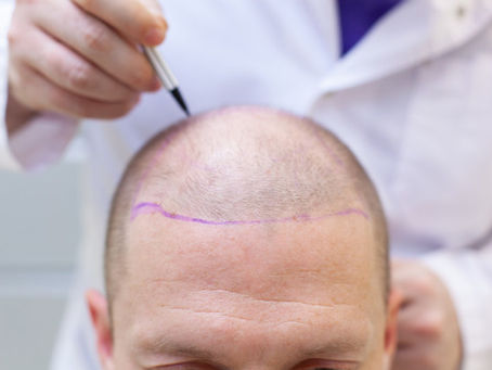 The Power of PRP Hair Treatment: How It Can Rejuvenate Your Hairline