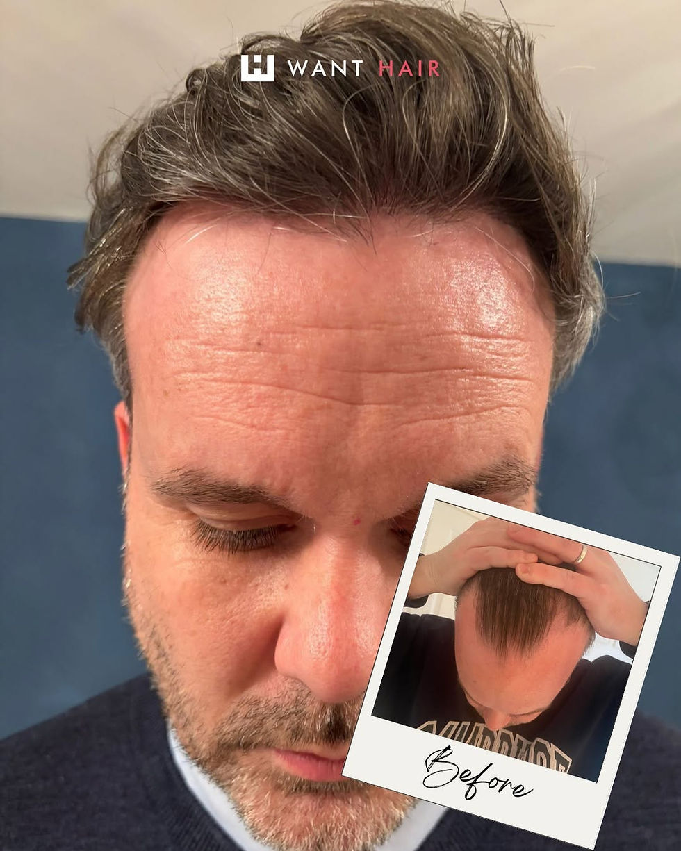 Leading Trusted Hair Transplant UK Clinics and Hair Specialists