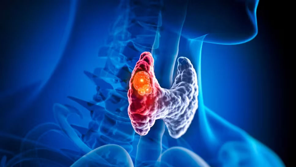 Medical illustration of thyroid cancer — a malignant nodule in the right lobe of the thyroid gland, treated with thyroidectomy by Dr Vyas Prasad at Absolute ENT, Singapore