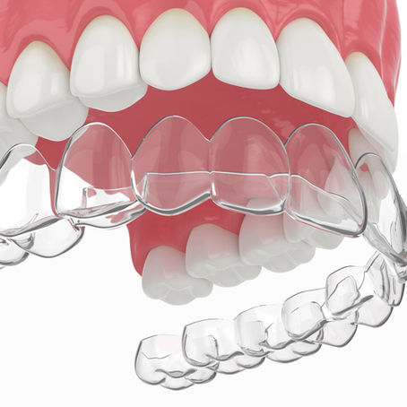 ¿Ortodoncia sin brackets?. Aqui están los alineadores que cambiaran tu sonrisa para siempre