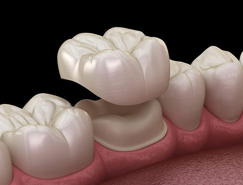 Dental Crown Tempe, AZ