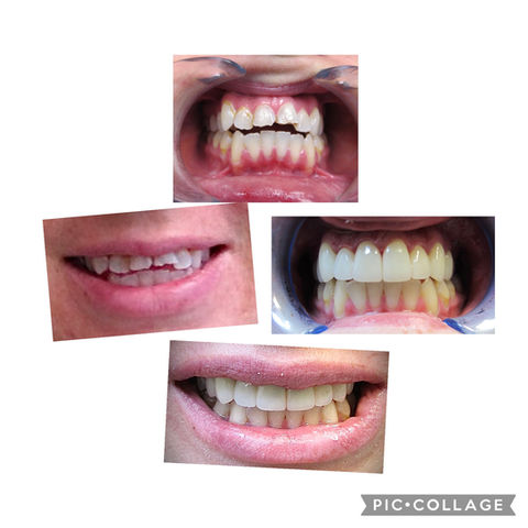Dental Crowns Tempe, AZ