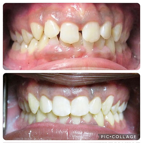 Teeth Whitening Tempe, AZ