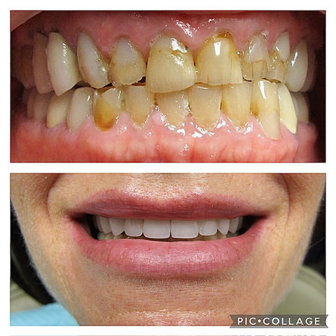 Veneers Tempe, AZ