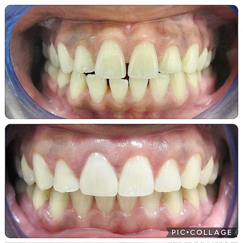 Invisalign Tempe
