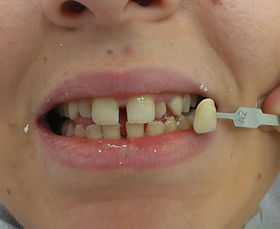 השלמת שיניים מקומפוזיט בטיפול מהיר אחד ללא כאבים וללא זריקות