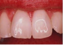 02_Bleaching_After.jpg