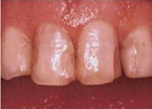 01_Bleaching_Bonding_Veneers_Crown_Before.jpg