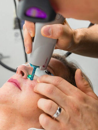 V Beam Laser