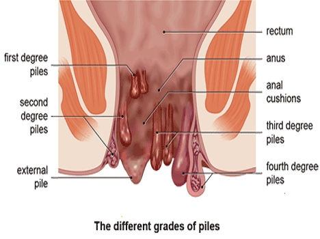 Piles